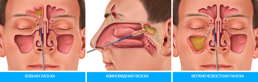 пазухи носа гайморит